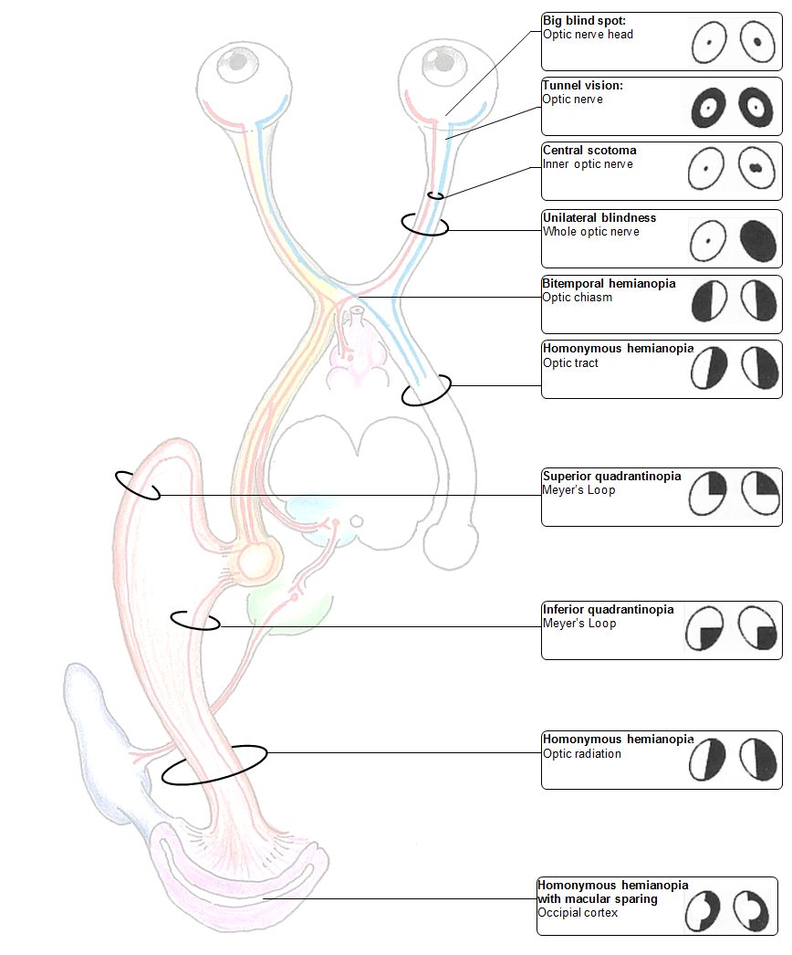 Visual fields and lesions of the visual pathways (CN II) Deranged Physiology